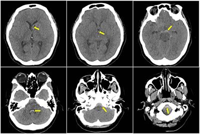 Intracranial Subarachnoid Haemorrhage Caused by Cervical Spinal Dural Arteriovenous Fistulas: Case Report